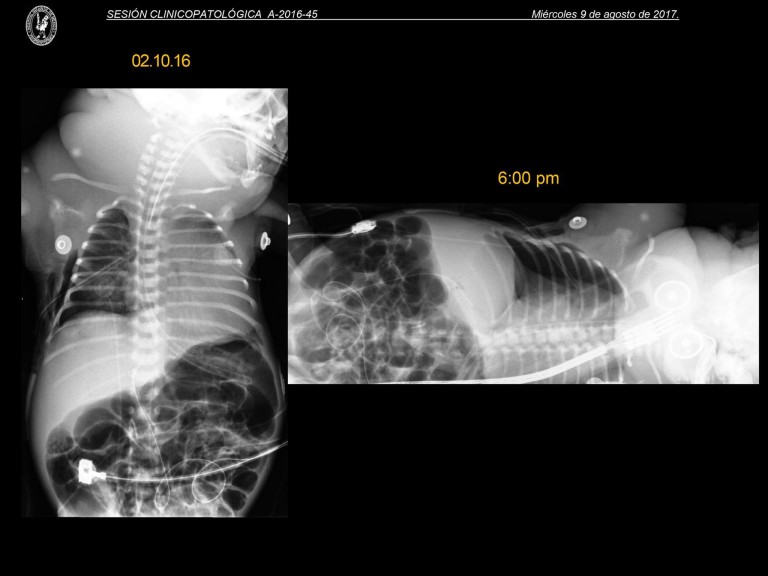Sesión Clínico Patológica HIMFG 9 de agosto 2017
